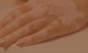 Vitiligo-04.jpg